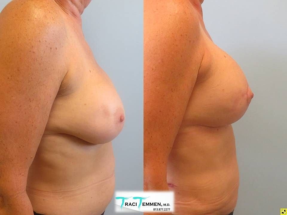 Breast Augmentation With Lift Before & After