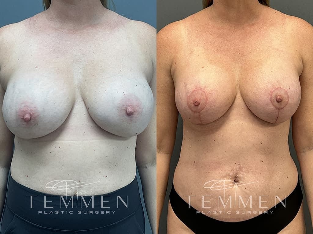Breast Augmentation With Lift Before & After