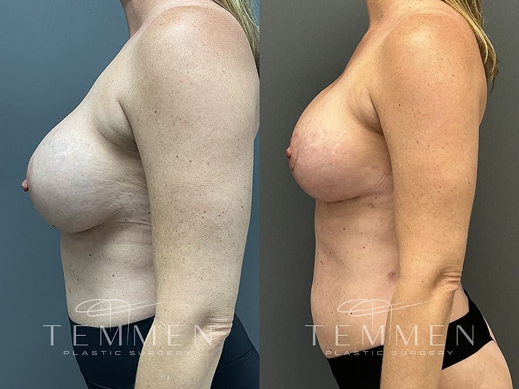 Breast Augmentation With Lift Before & After