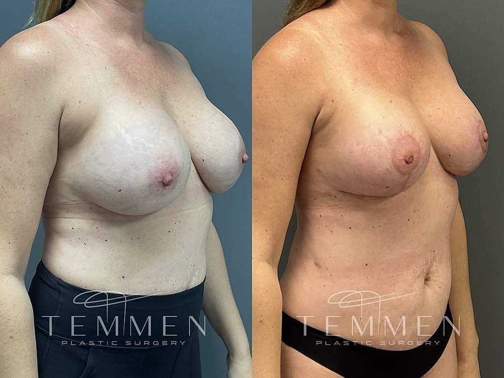 Breast Augmentation With Lift Before & After