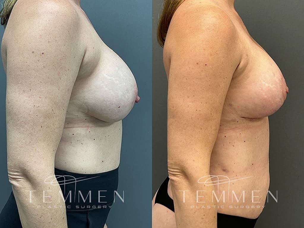 Breast Augmentation With Lift Before & After