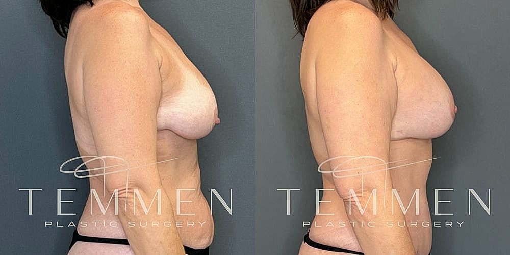 Before and after plastic surgery side view.