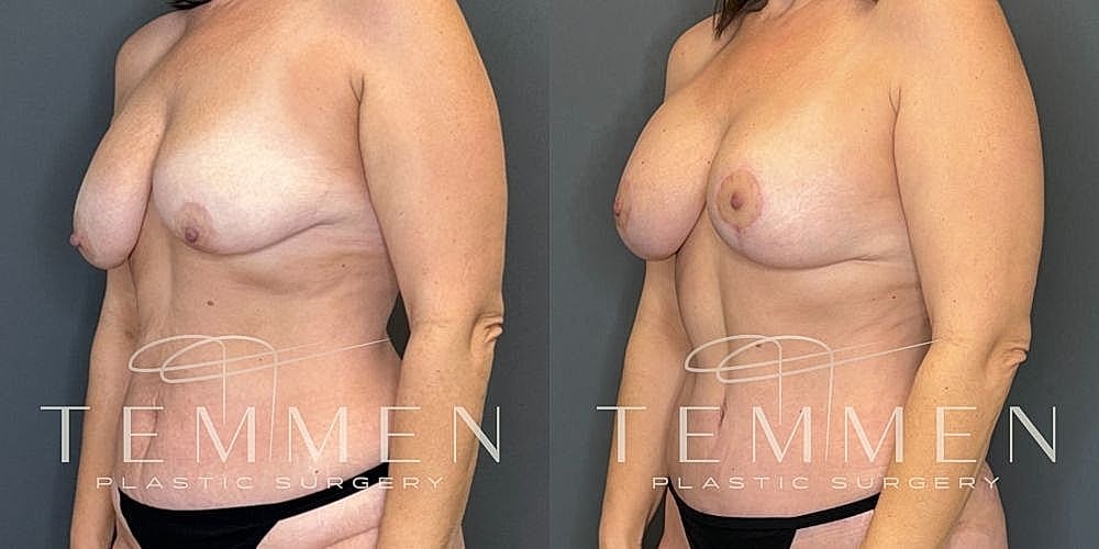 Before and after breast surgery transformation image