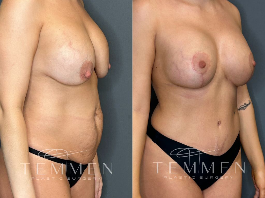 Breast Augmentation With Lift Before & After