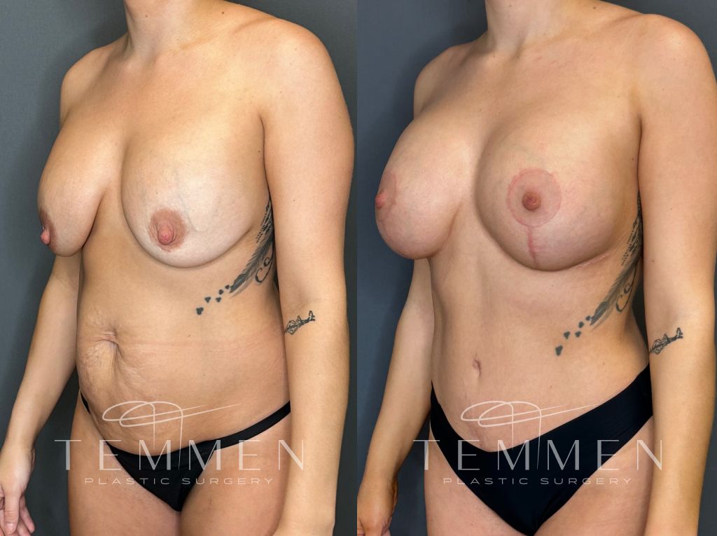 Breast Augmentation With Lift Before & After