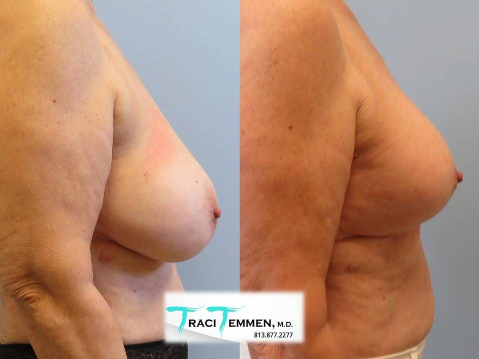 Breast Augmentation With Lift Before & After