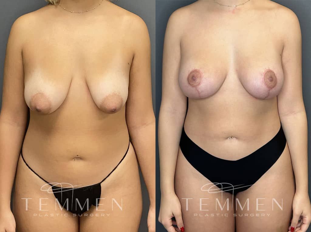Breast Augmentation With Lift Before & After