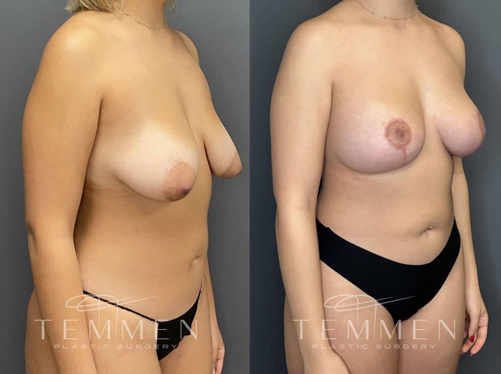Breast Augmentation With Lift Before & After
