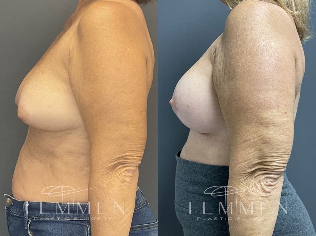 Breast Augmentation With Lift Before & After