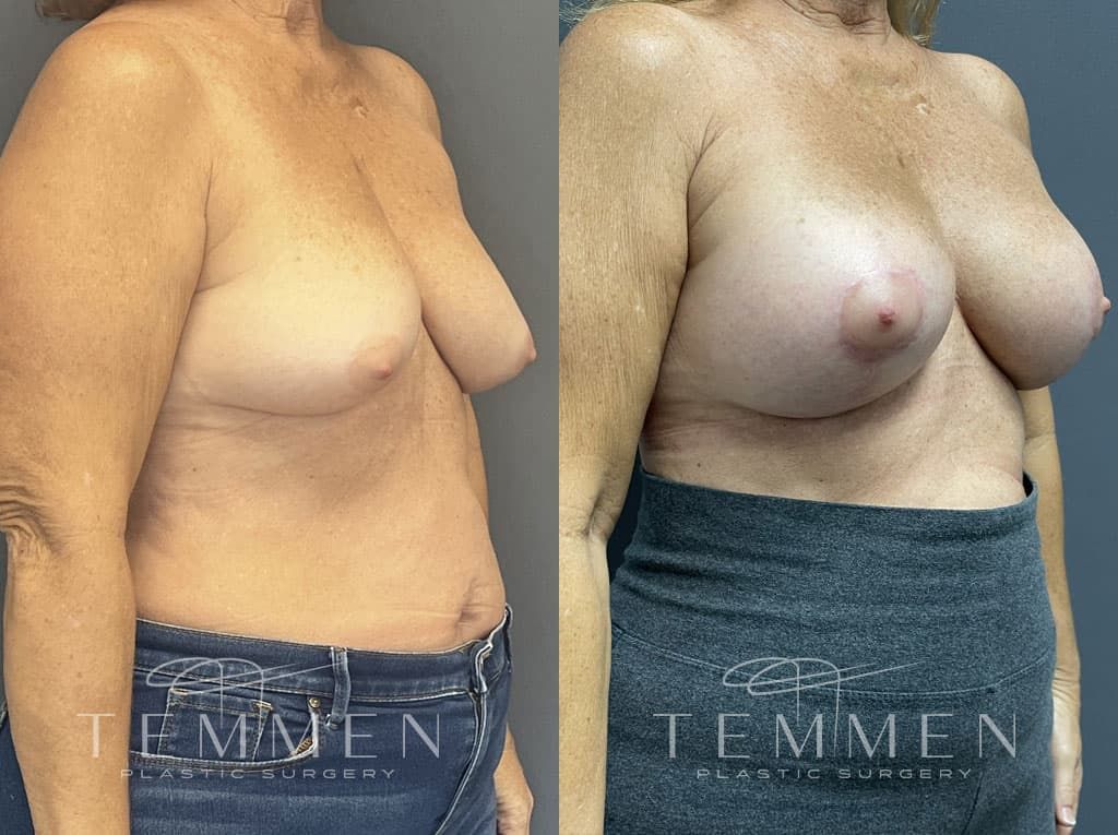 Breast Augmentation With Lift Before & After