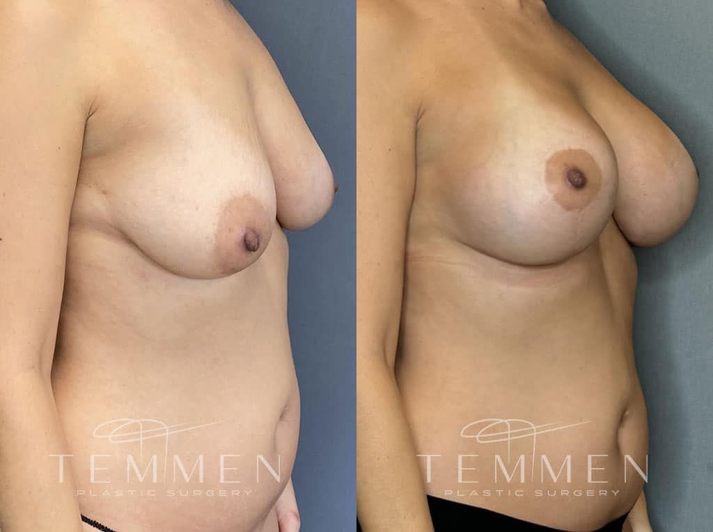 Breast Augmentation With Lift Before & After