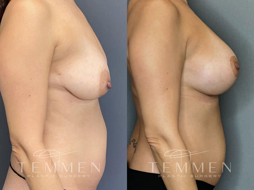 Breast Augmentation With Lift Before & After