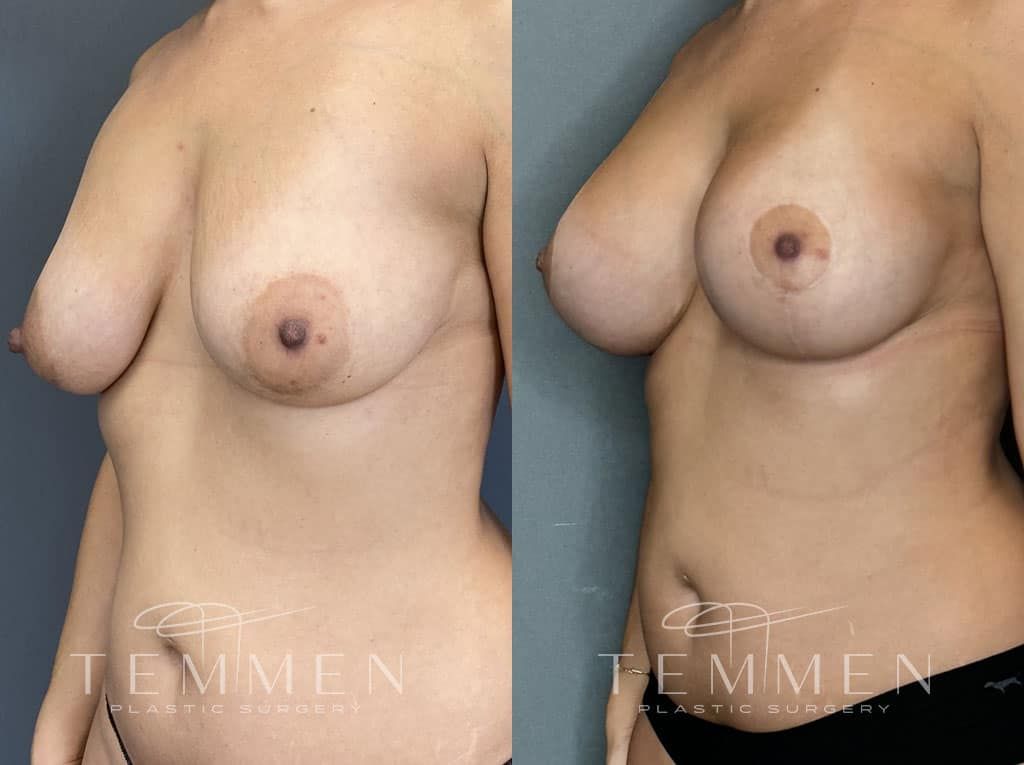 Breast Augmentation With Lift Before & After