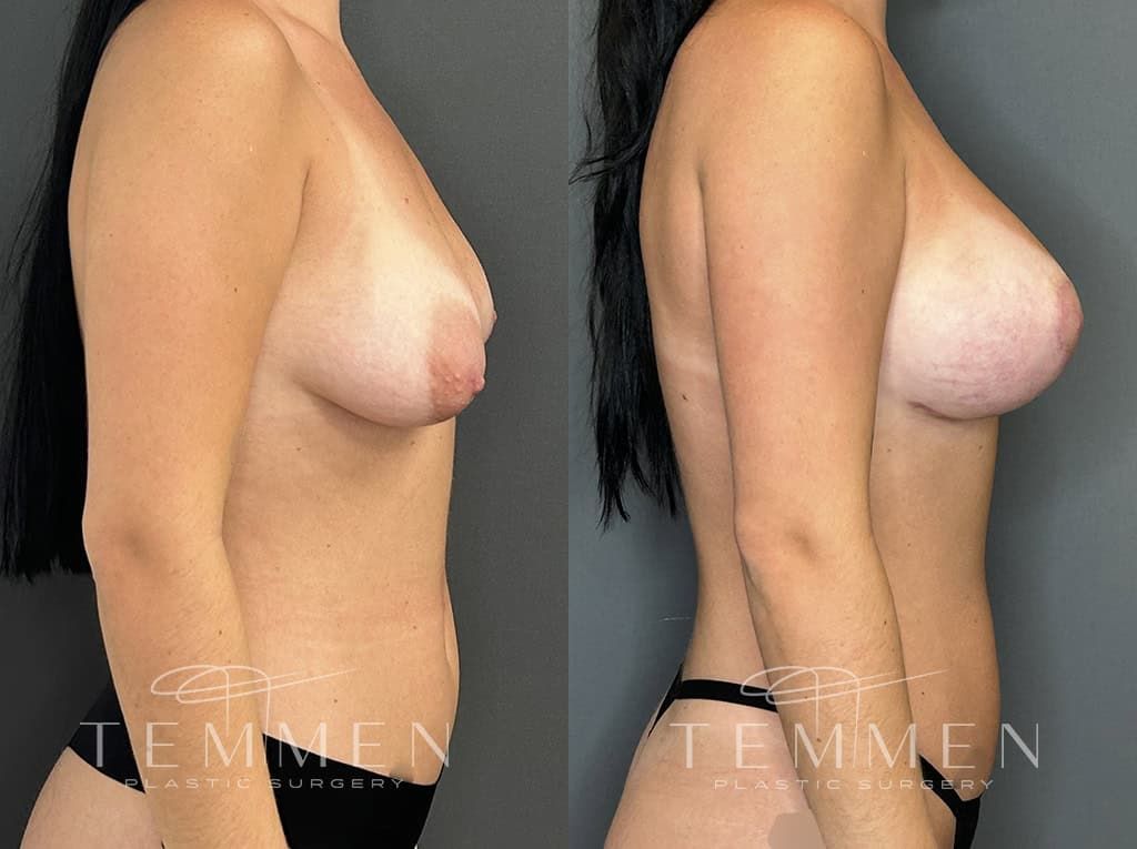 Breast Augmentation With Lift Before & After