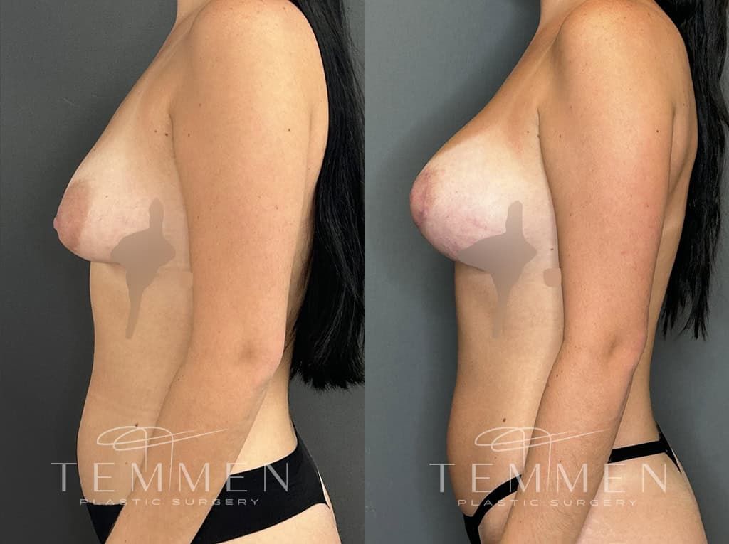 Breast Augmentation With Lift Before & After