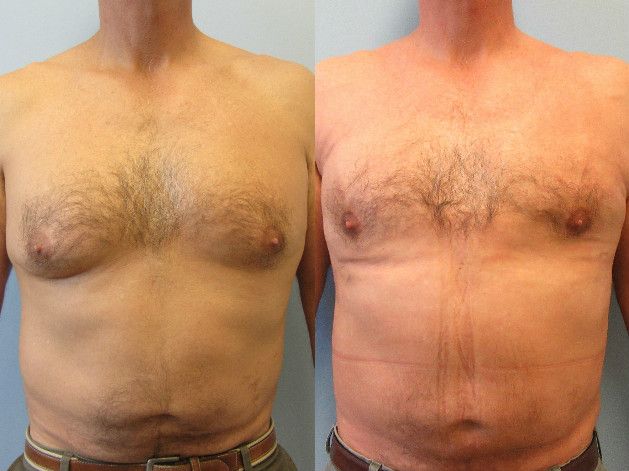 Gynecomastia Before & After