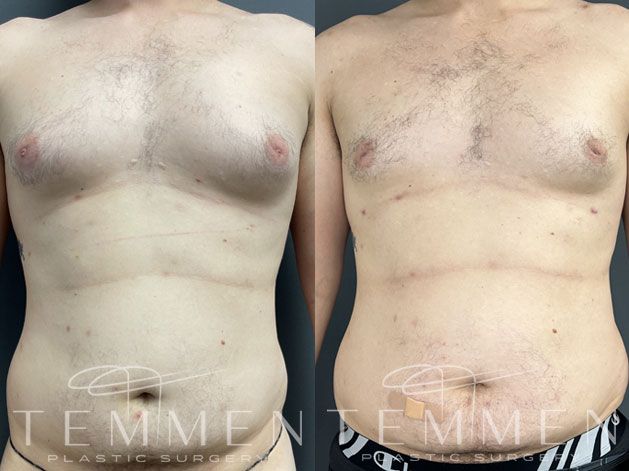Gynecomastia Before & After