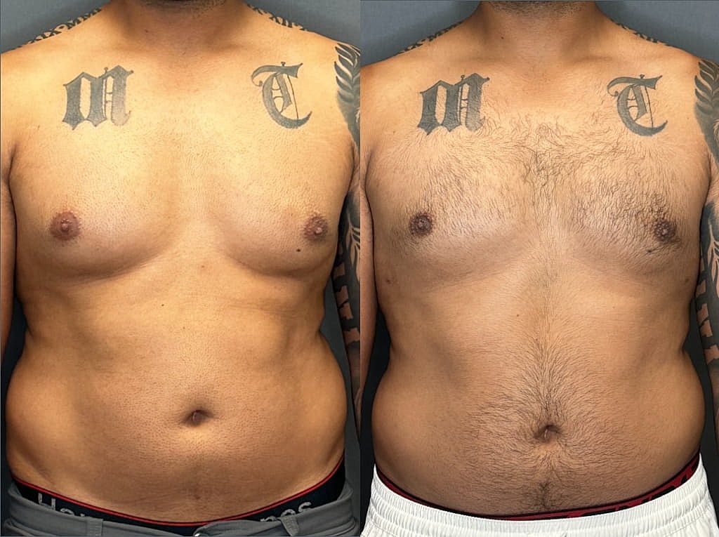 Gynecomastia Before & After