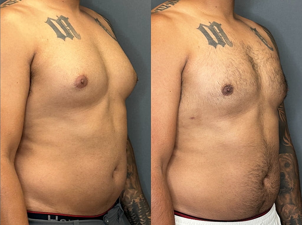 Gynecomastia Before & After