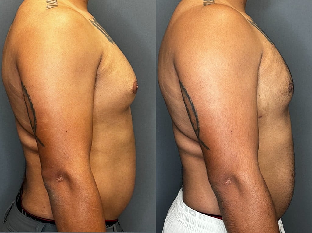 Gynecomastia Before & After