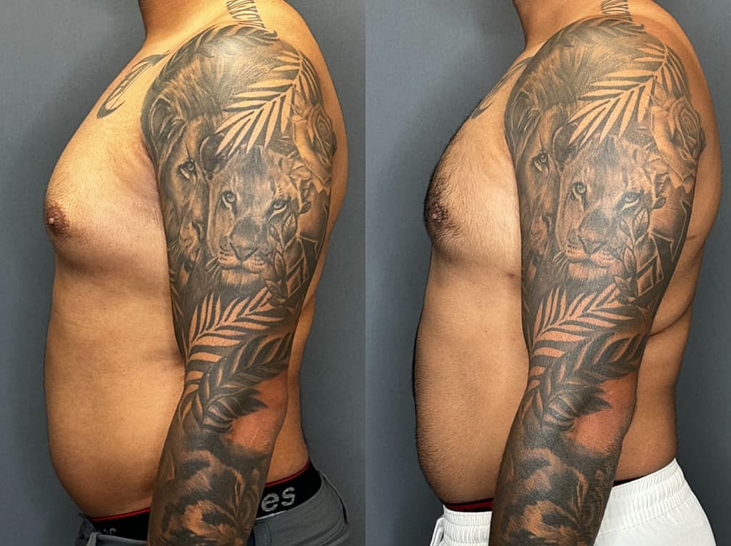 Gynecomastia Before & After