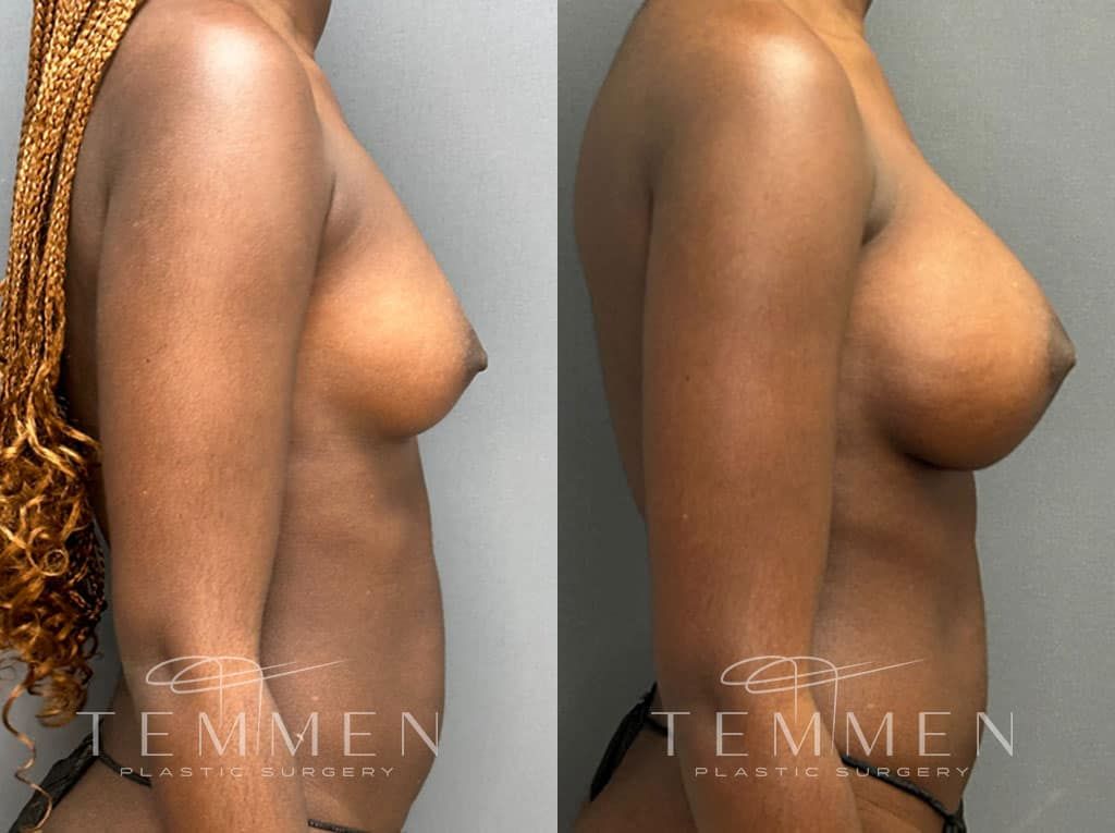 Breast Augmentation Before & After