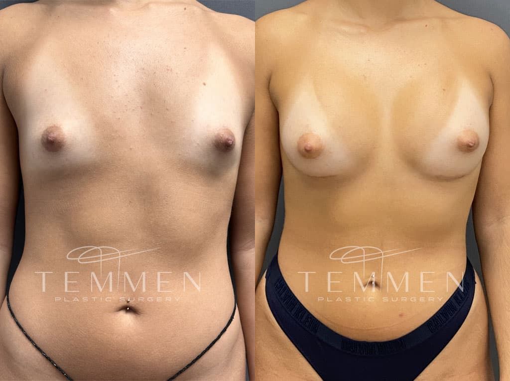 Breast Augmentation Before & After