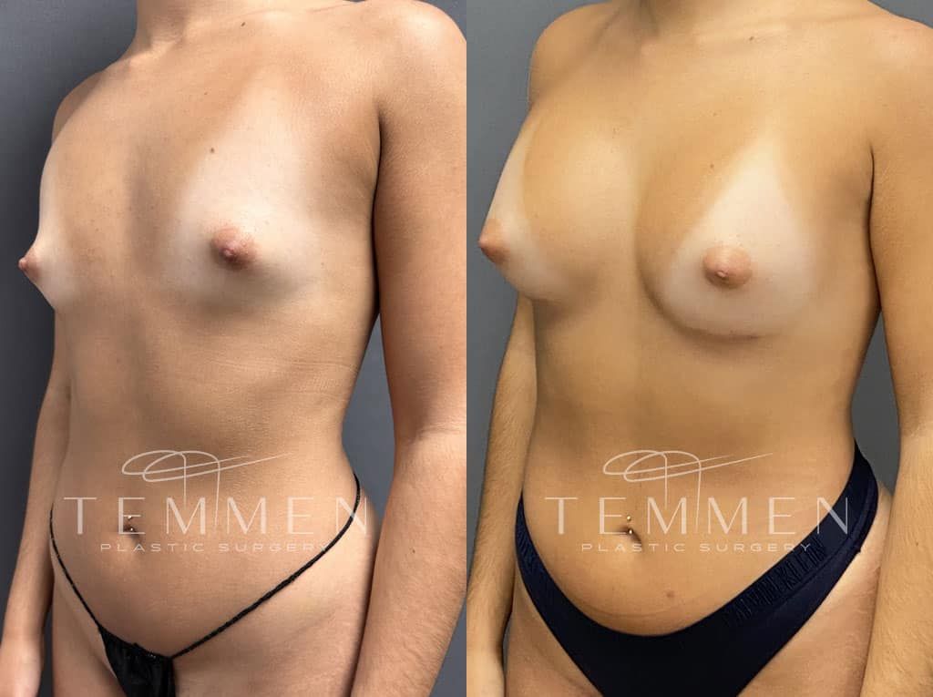 Breast Augmentation Before & After