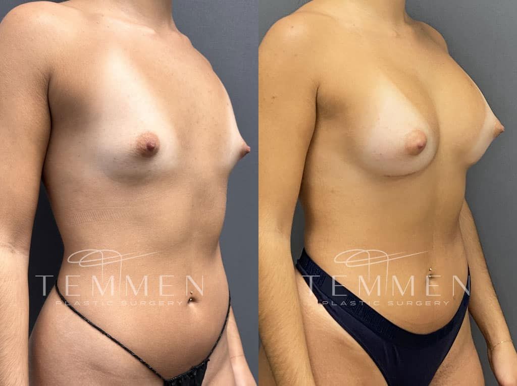 Breast Augmentation Before & After
