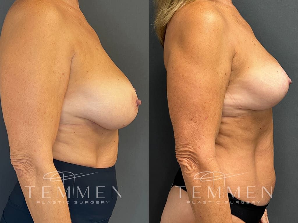 Breast Augmentation Before & After