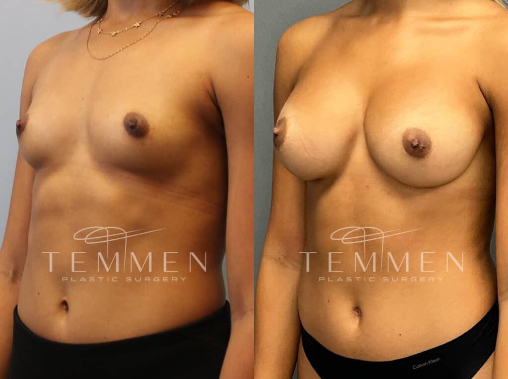 Breast Augmentation Before & After