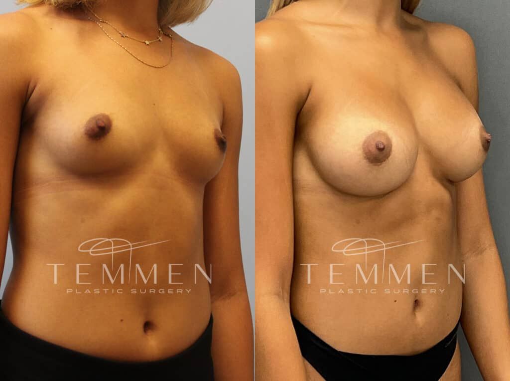 Breast Augmentation Before & After