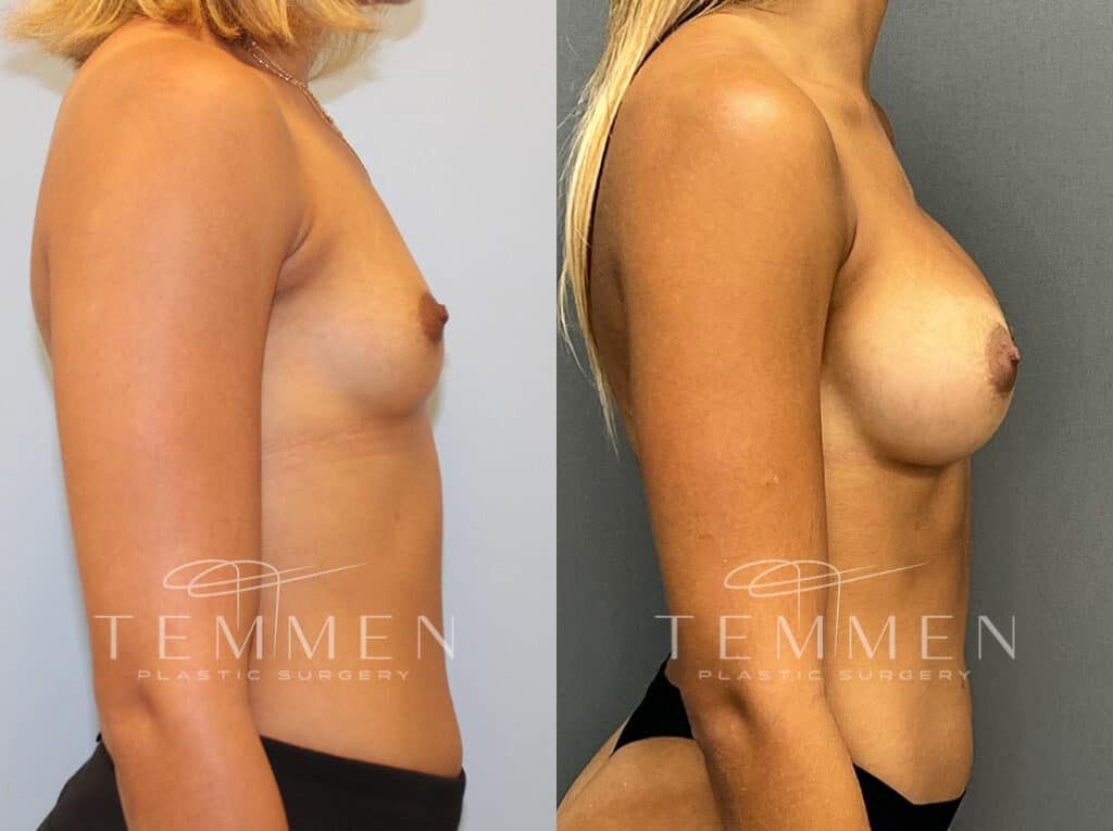 Breast Augmentation Before & After