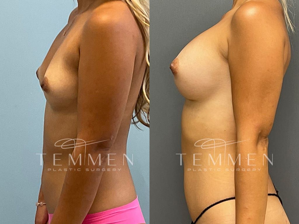 Breast Augmentation Before & After