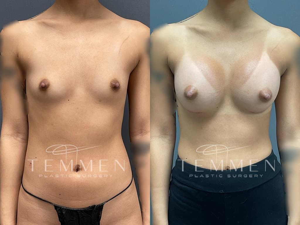 Breast Augmentation Before & After