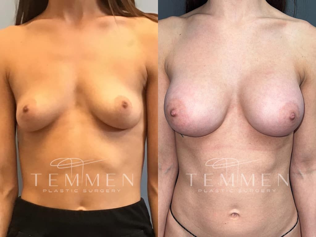 Breast Augmentation Before & After