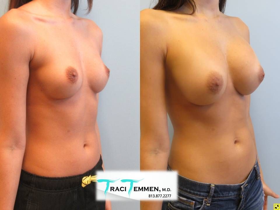 Breast Augmentation Before & After