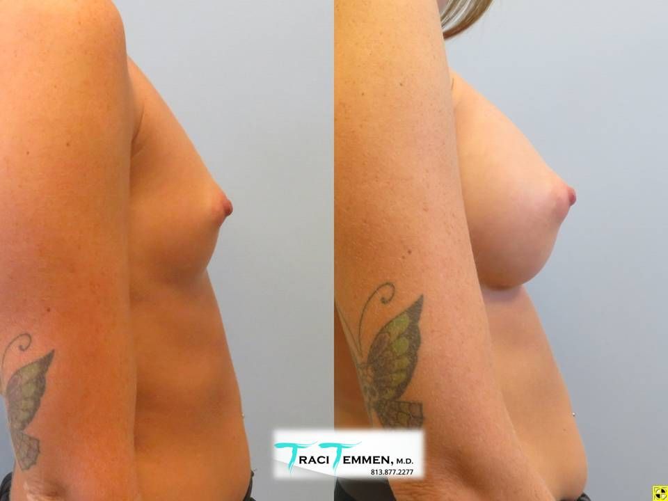 Breast Augmentation Before & After