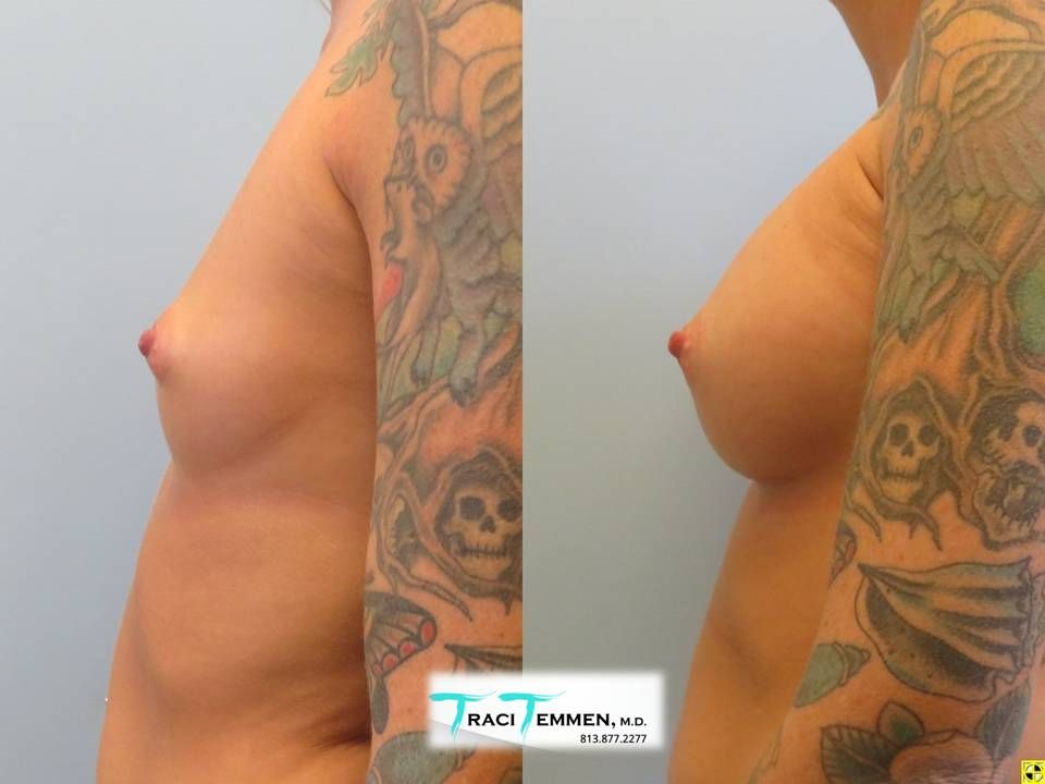 Breast Augmentation Before & After