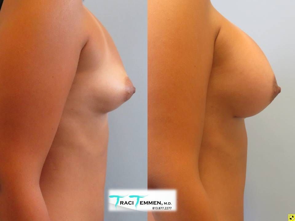 Breast Augmentation Before & After