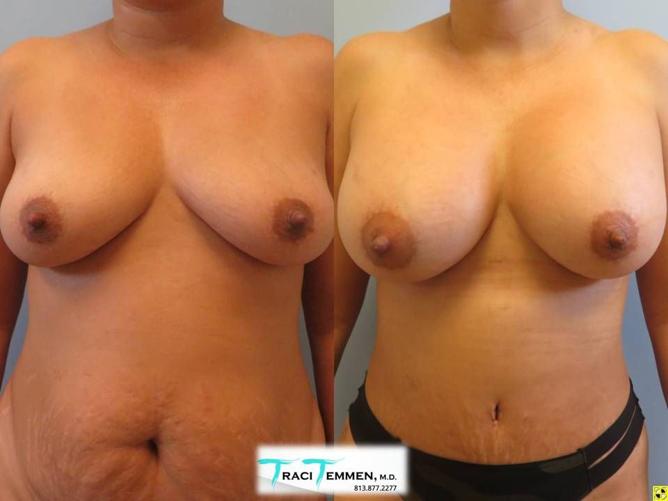 Breast Augmentation Before & After