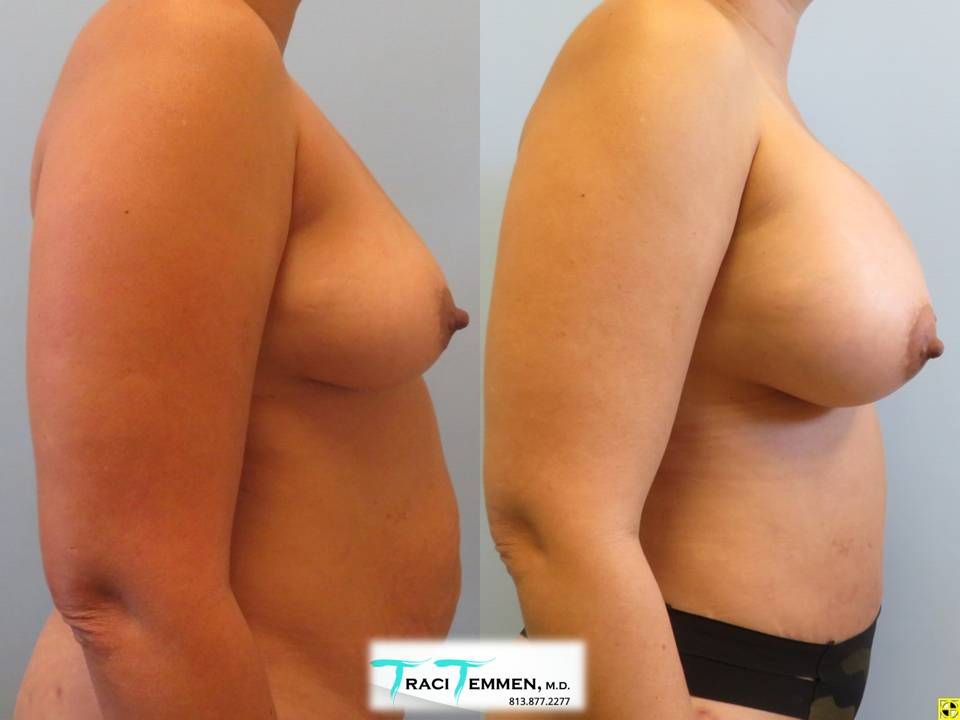 Breast Augmentation Before & After