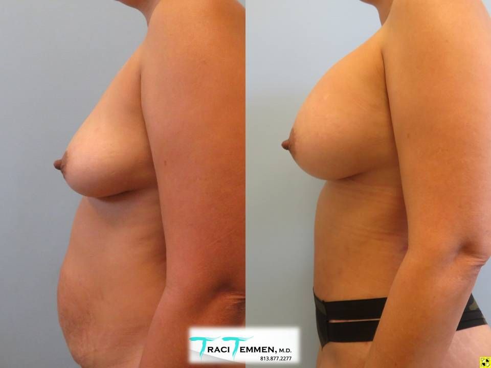 Breast Augmentation Before & After
