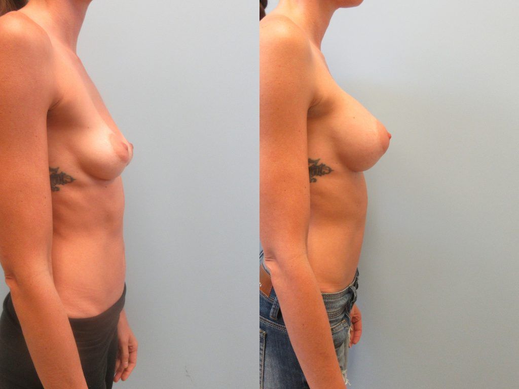 Breast Augmentation Before & After