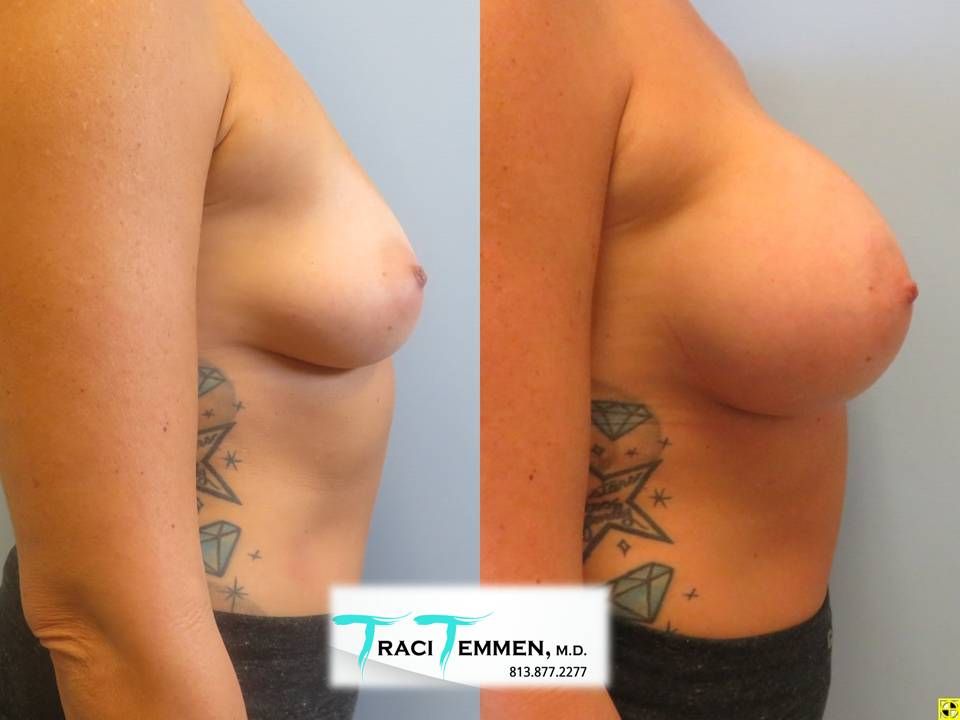 Breast Augmentation Before & After