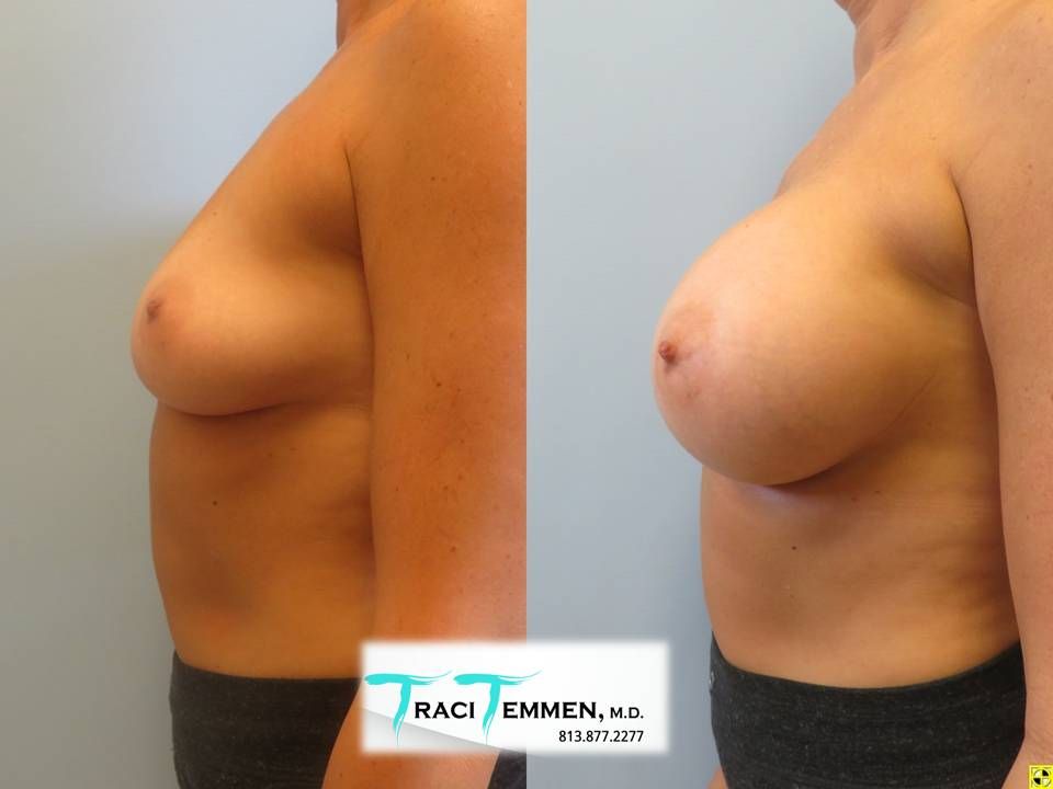 Breast Augmentation Before & After