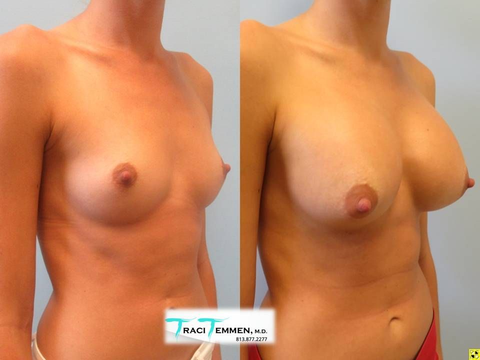 Breast Augmentation Before & After