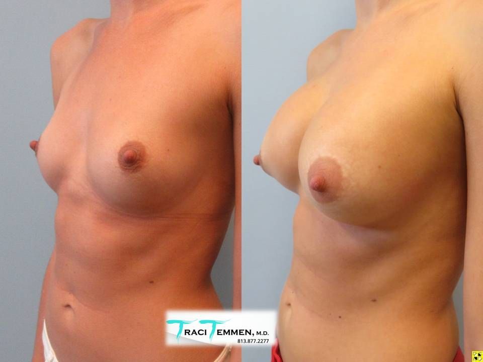 Breast Augmentation Before & After