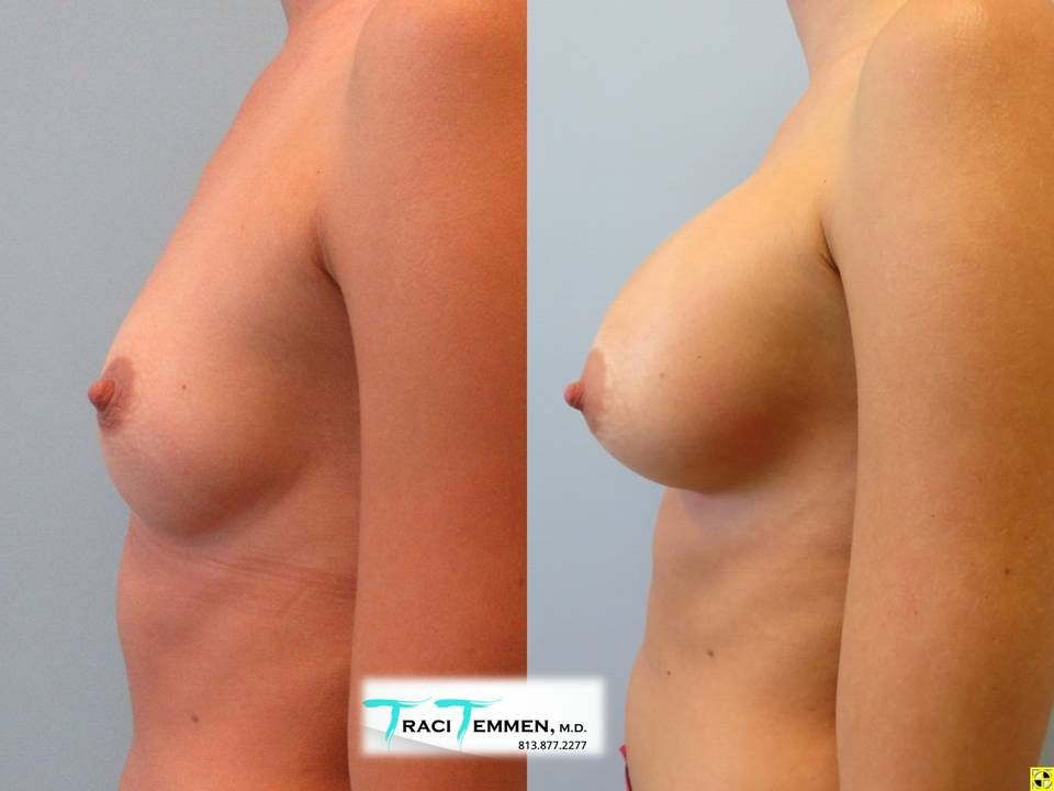 Breast Augmentation Before & After