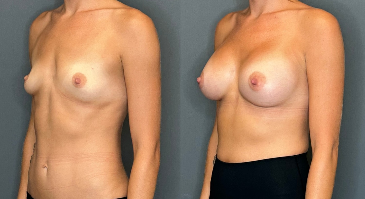 Breast Augmentation Before & After